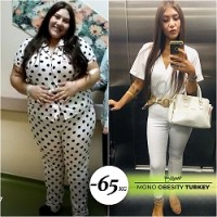 monoobesity surgery