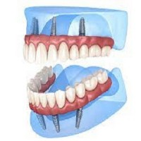 all on four dental implants in mexico